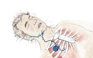 Although CPAP is an effective treatment for OSA, many patients discontinue its use within 3 years. <i>Photo Credit: Nicole R. Fuller/Science Source</i> Although CPAP is an effective treatment for OSA, many patients discontinue its use within 3 years. <i>Photo Credit: Nicole R. Fuller/Science Source</i>