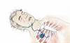 Hypoglossal Nerve Stimulation in OSA: A Viable Alternative to CPAP Hypoglossal Nerve Stimulation in OSA: A Viable Alternative to CPAP
