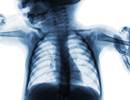 Radiography Still Common in Pediatric Bronchiolitis Despite AAP Guidelines Radiography Still Common in Pediatric Bronchiolitis Despite AAP Guidelines