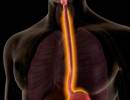 Eosinophilic Esophagitis Symptoms Reduced With Anti-Interleukin 13 Antibody Eosinophilic Esophagitis Symptoms Reduced With Anti-Interleukin 13 Antibody