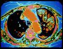 Endobronchial Valve Therapy: A Nonsurgical Option for Advanced Emphysema Endobronchial Valve Therapy: A Nonsurgical Option for Advanced Emphysema