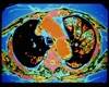 Endobronchial Valve Therapy: A Nonsurgical Option for Advanced Emphysema Endobronchial Valve Therapy: A Nonsurgical Option for Advanced Emphysema