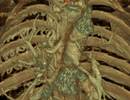 Pulmonary Hypertension Screening Adaptations for Adult Congenital Heart Disease Subtypes Pulmonary Hypertension Screening Adaptations for Adult Congenital Heart Disease Subtypes