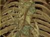 Pulmonary Hypertension Screening Adaptations for Adult Congenital Heart Disease Subtypes Pulmonary Hypertension Screening Adaptations for Adult Congenital Heart Disease Subtypes