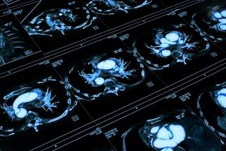 Pulmonary artery aneurysms were more frequently detected in patients with congenital heart disease and toxic oil syndrome. Pulmonary artery aneurysms were more frequently detected in patients with congenital heart disease and toxic oil syndrome.