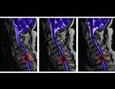 Sleep-Disordered Breathing: Imposing Challenges in Spinal Cord Injury Sleep-Disordered Breathing: Imposing Challenges in Spinal Cord Injury