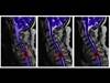 Sleep-Disordered Breathing: Imposing Challenges in Spinal Cord Injury Sleep-Disordered Breathing: Imposing Challenges in Spinal Cord Injury