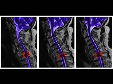 Sleep-Disordered Breathing: Imposing Challenges in Spinal Cord Injury Sleep-Disordered Breathing: Imposing Challenges in Spinal Cord Injury