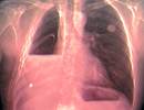 Malignant Pleural Effusion Interventions: What Matters Most to the Patient? Malignant Pleural Effusion Interventions: What Matters Most to the Patient?