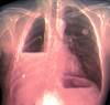 Malignant Pleural Effusion Interventions: What Matters Most to the Patient? Malignant Pleural Effusion Interventions: What Matters Most to the Patient?