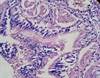 Primary Ciliary Dyskinesia: Practical Pearls for Diagnosis Primary Ciliary Dyskinesia: Practical Pearls for Diagnosis