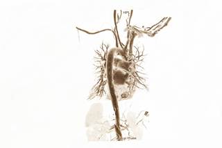 In addition, oscillatory shear index increased significantly in the main pulmonary artery based on PAH severity. In addition, oscillatory shear index increased significantly in the main pulmonary artery based on PAH severity.