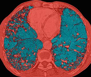The mortality rate in patients with ILD increased by 40% for each 5% increase in the extent of CT honeycombing. The mortality rate in patients with ILD increased by 40% for each 5% increase in the extent of CT honeycombing.