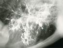 Buying Time to First Exacerbation in Non-Cystic Fibrosis Bronchiectasis Buying Time to First Exacerbation in Non-Cystic Fibrosis Bronchiectasis