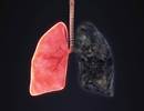Inflammatory Markers in COPD Linked to Increased Symptom Burden in Smokers Inflammatory Markers in COPD Linked to Increased Symptom Burden in Smokers