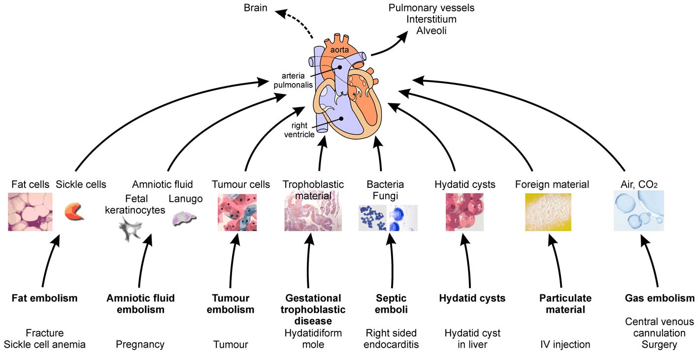 aok treatment for amniotic fluid embolism