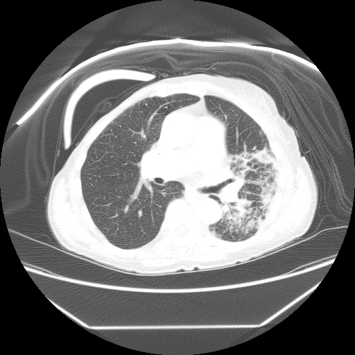 RadiationInduced Lung Injury