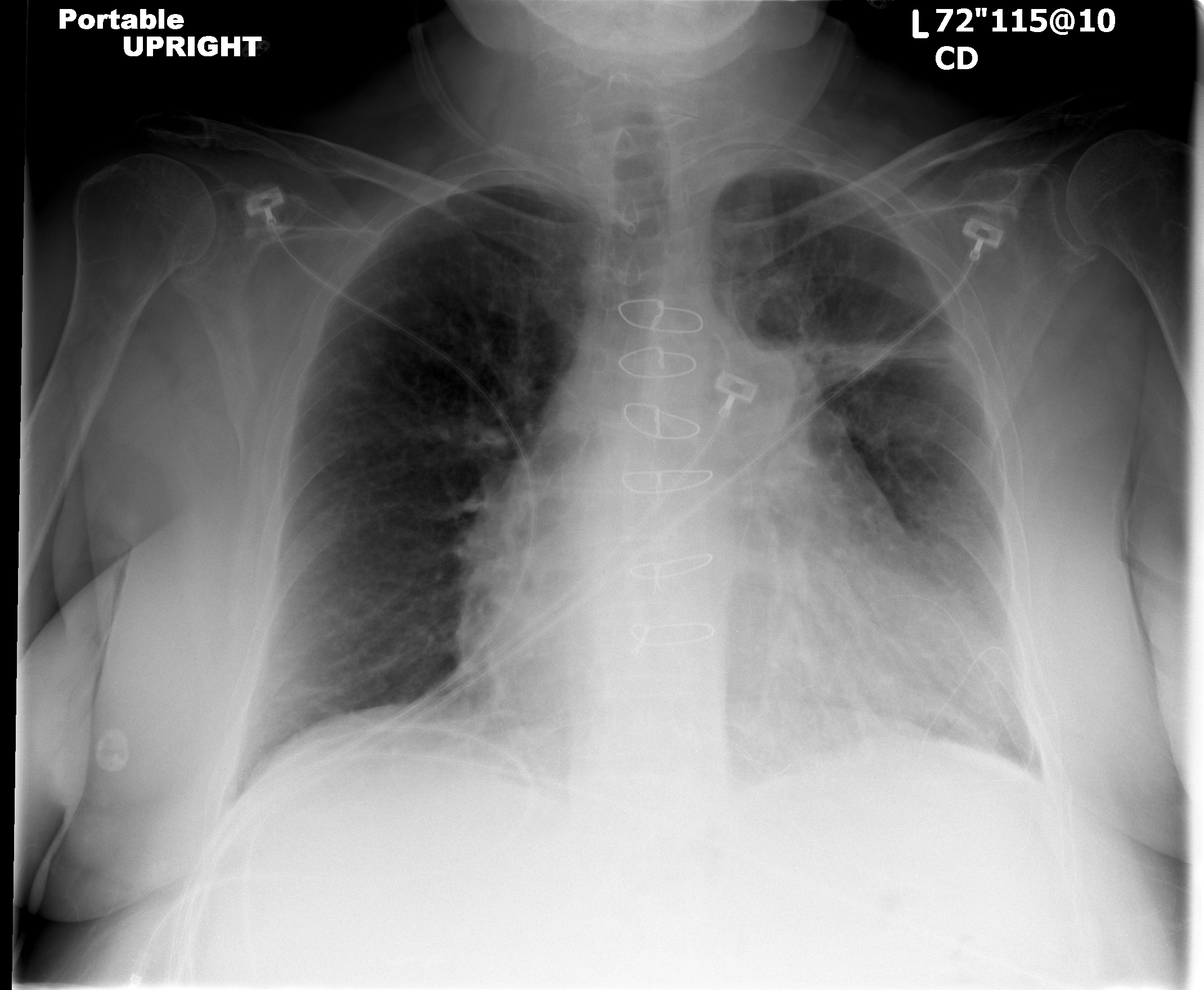 Radiation-Induced Lung Injury